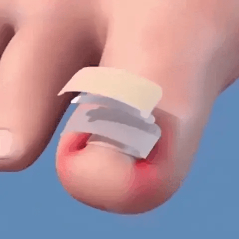 ComfortNail™  – 30 Parches para Uñas Encarnadas.